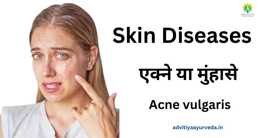 एक्ने या मुंहासे: Acne vulgaris,