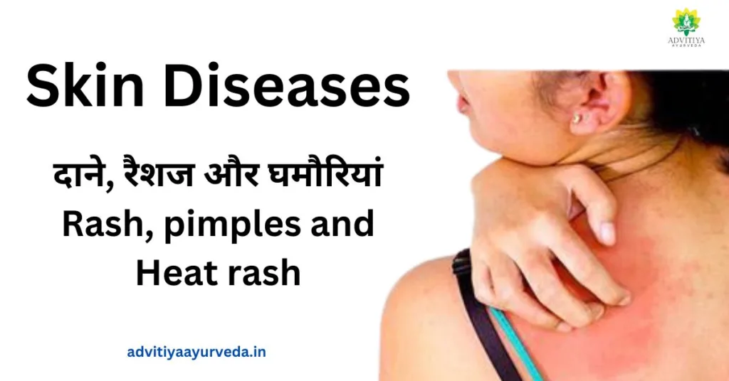 दाने, रैशज और घमौरियां Rash, pimples and Heat rash