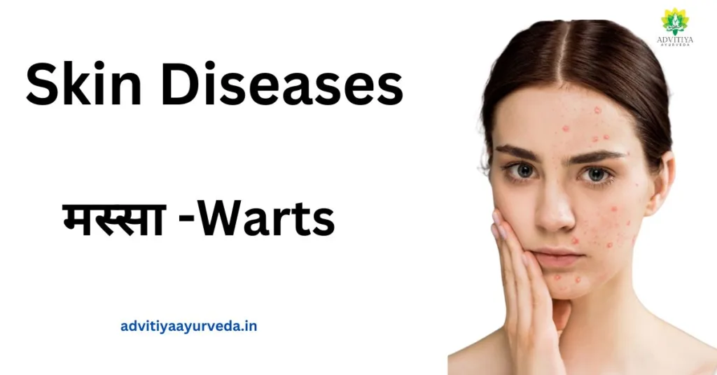 मस्सा -Warts